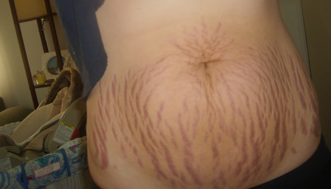 Do stretch marks go away or they will stay forever 